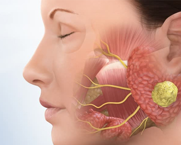 Salivary Gland Tumor Treatment in Delhi